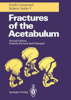 Picture of Fractures of the Acetabulum