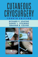 Picture of Cutaneous Cryosurgery